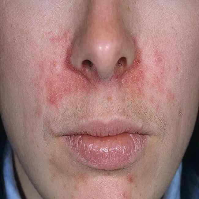 wysypka na twarzy u dorosłych 