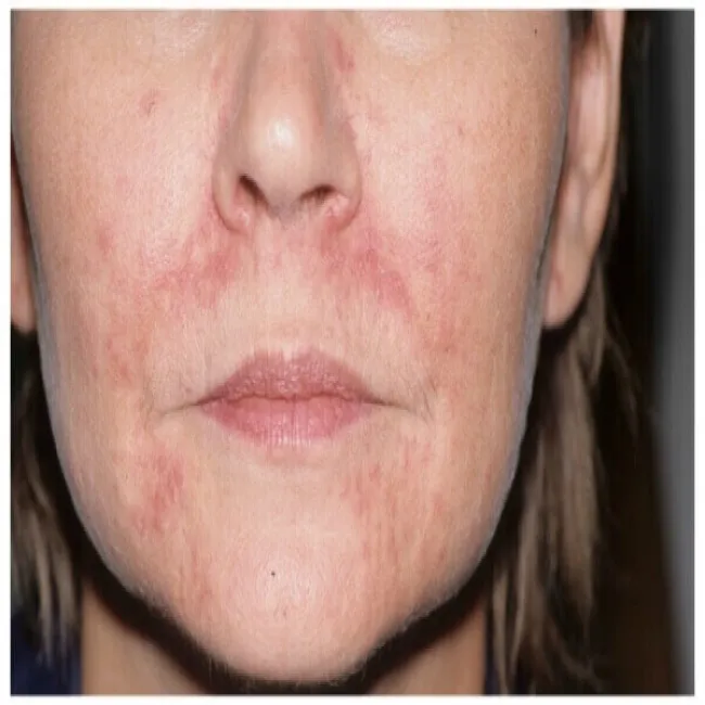 wysypka na twarzy zdjęcia zapalenie okołoustne 