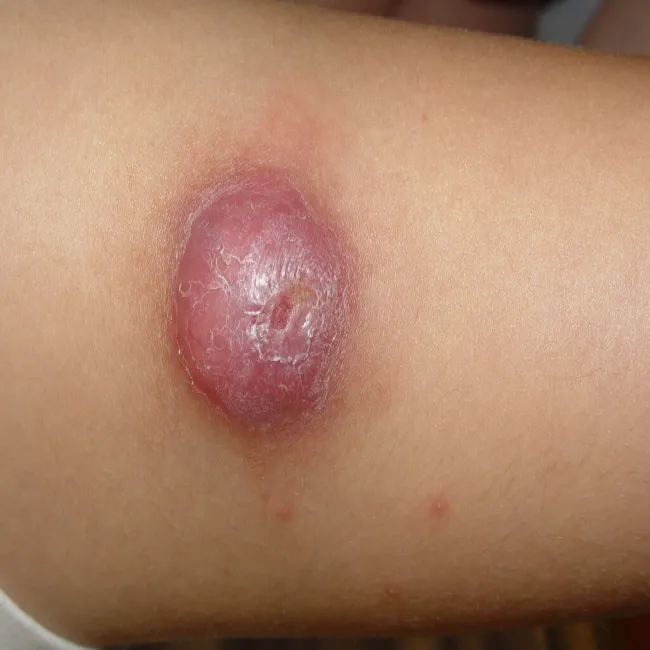 xanthogranuloma juvenile na skórze