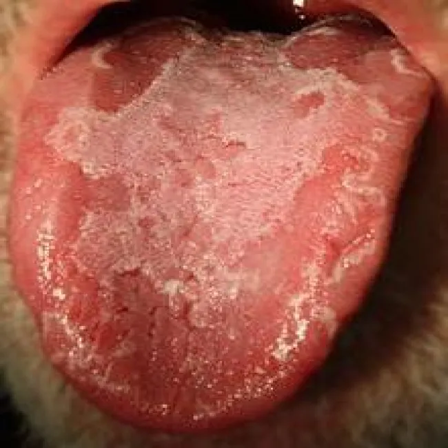 złuszczające zapalenie języka