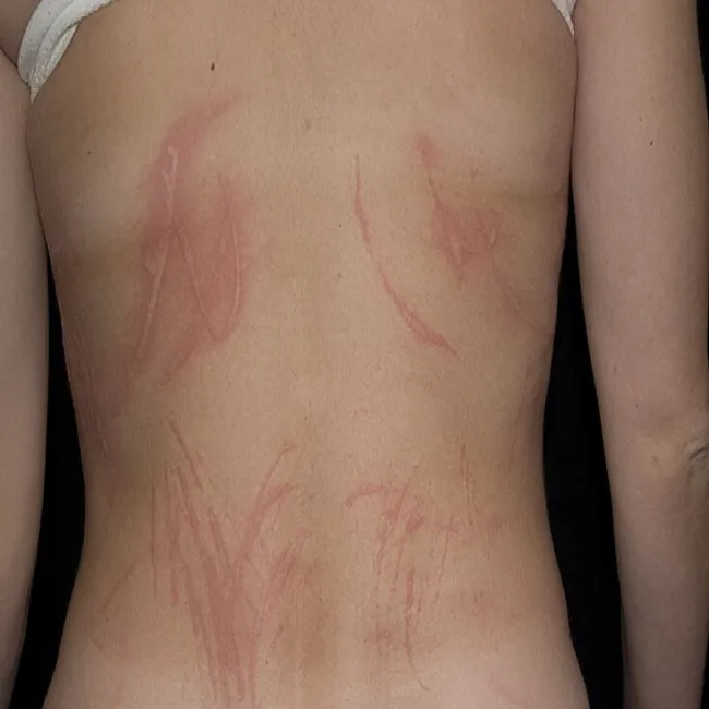 zaczerwienienia i pęcherze pokrzywka dermograficzna