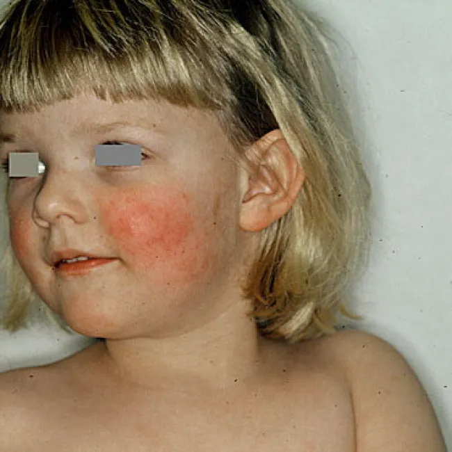 zaczerwienienia na policzkach