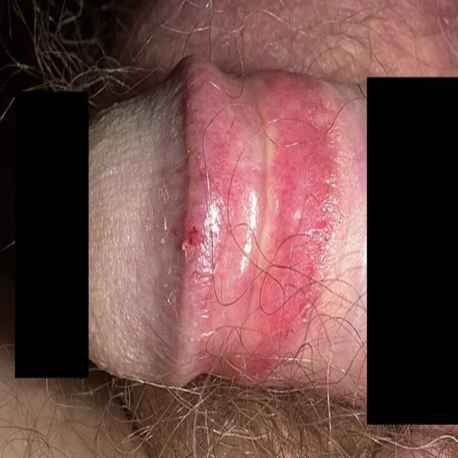 zaczerwienienie napletka po stosunku zapalenie napletka