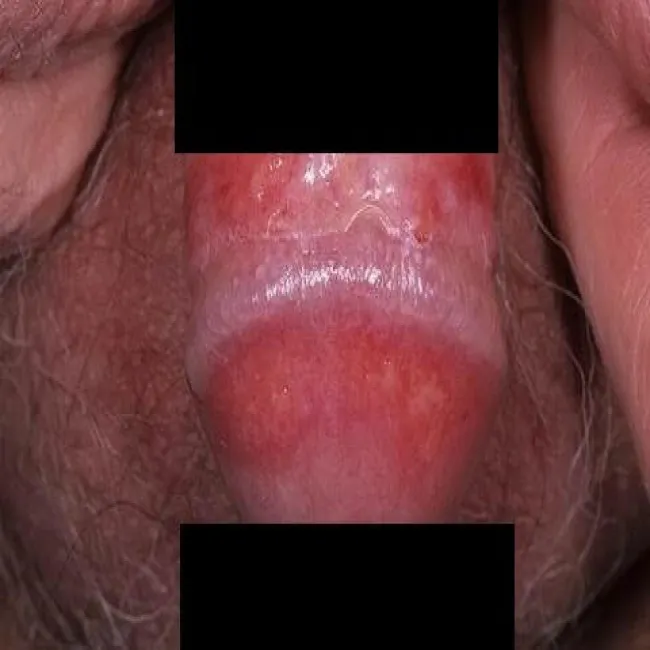 zaczerwienienie napletka zapalenie napletka