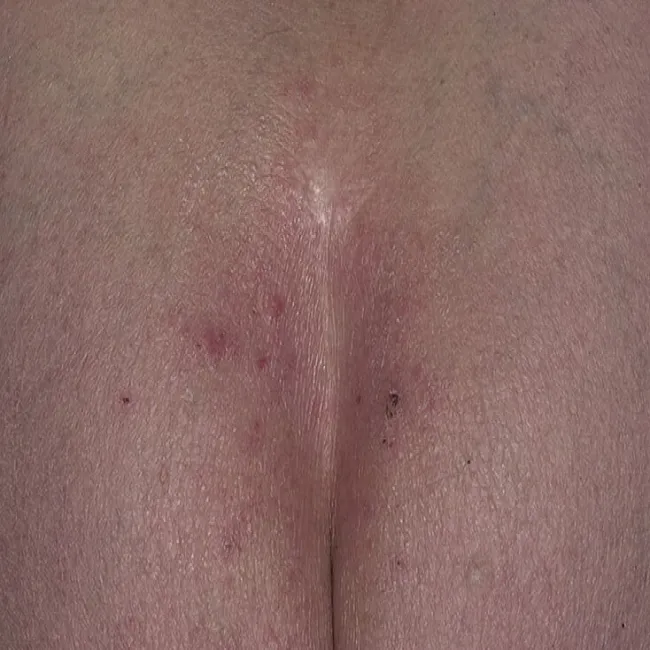 zaczerwienienie rowka między pośladkami 