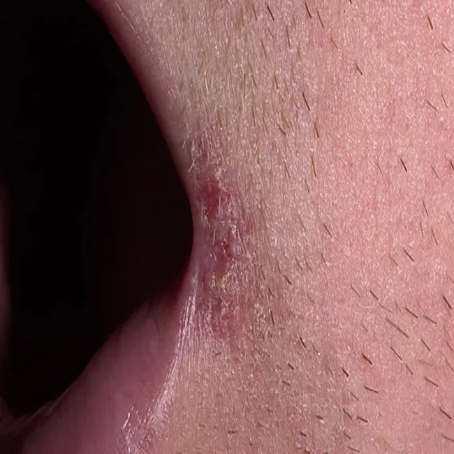 zaczerwienienie w kącikach ust