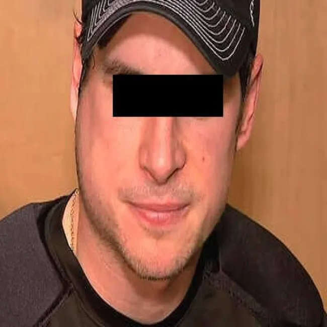 zapalenie ślinianki podżuchwowej świnka