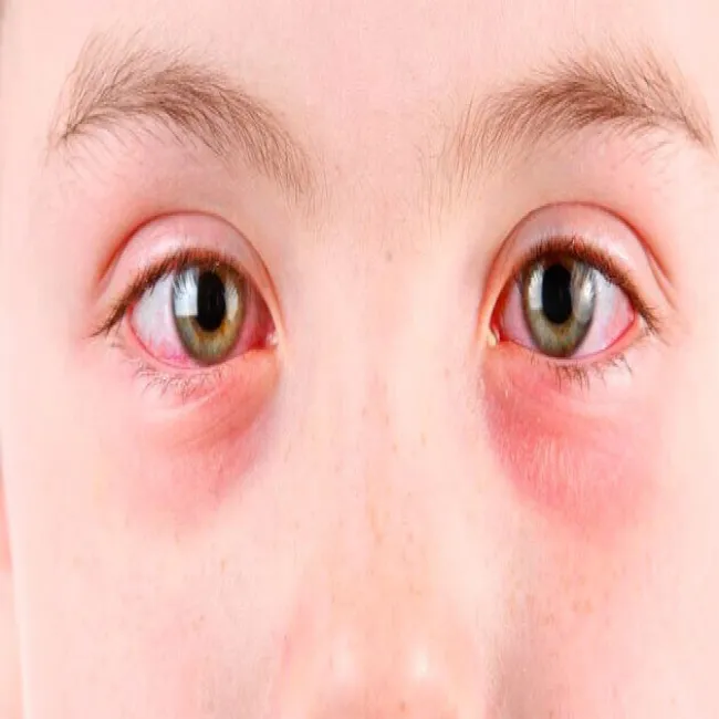 zapalenie brzegów powiek u dzieci