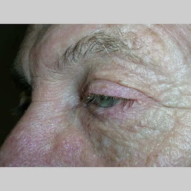 zapalenie brzegów powieki u osób starszych