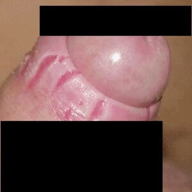 zapalenie napletka zdjęcie