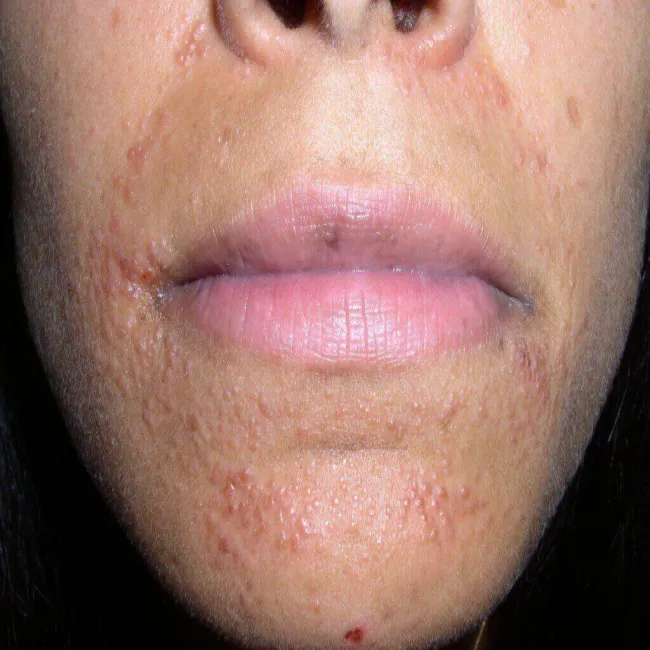 zapalenie okołoustne jak wygląda