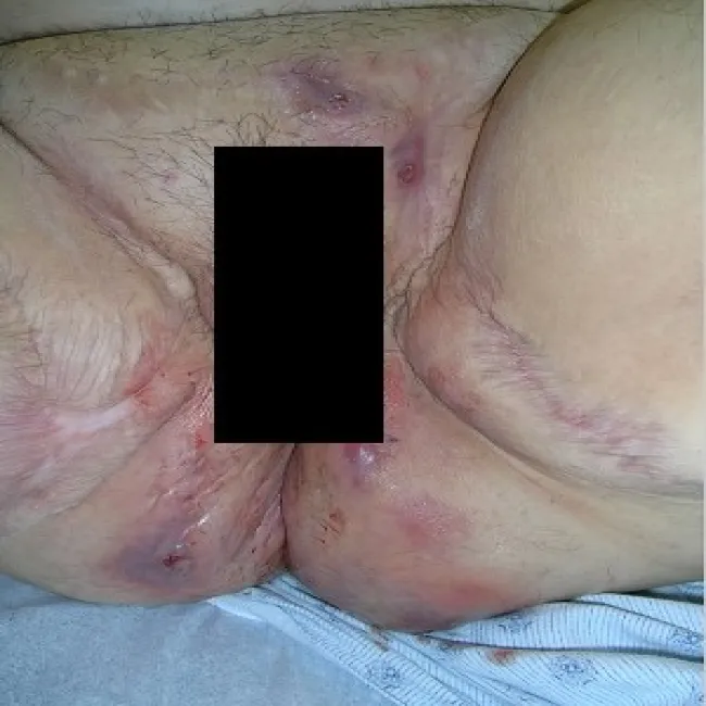 zapalenie okolic intymnych ropne zapalenie apokrynowych gruczołów potowych