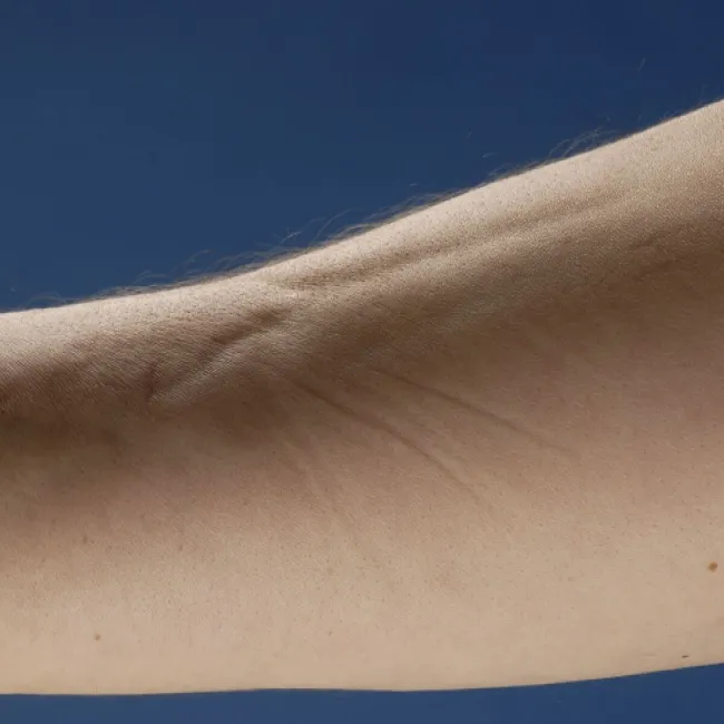 zapaleniem powięzi z eozynofilią