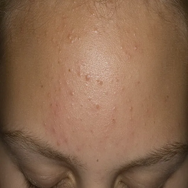 zaskórniki zamknięte kaszka na czole