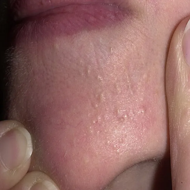 zaskórniki zamknięte na twarzy