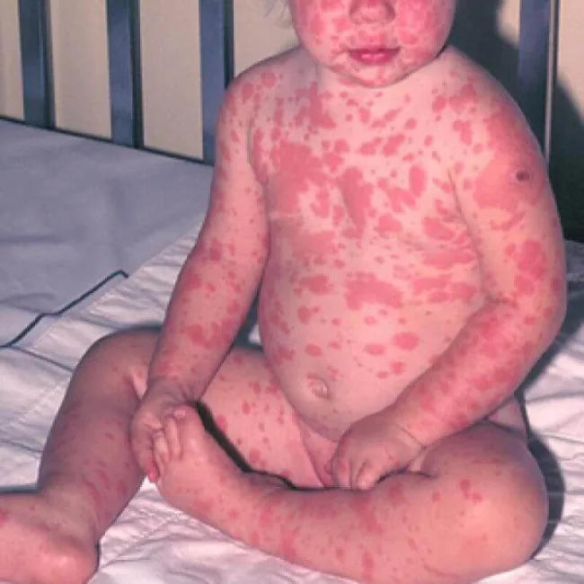 zespół lyella u dzieci