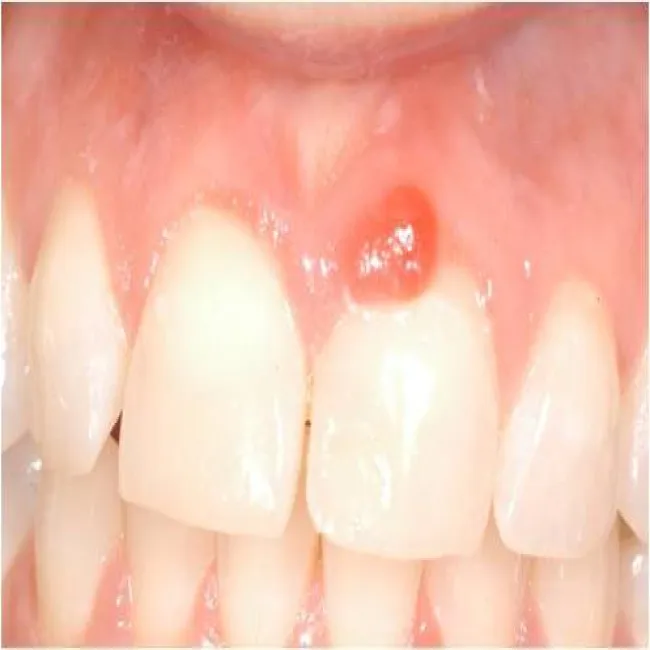 ziarniniak ciężarnych