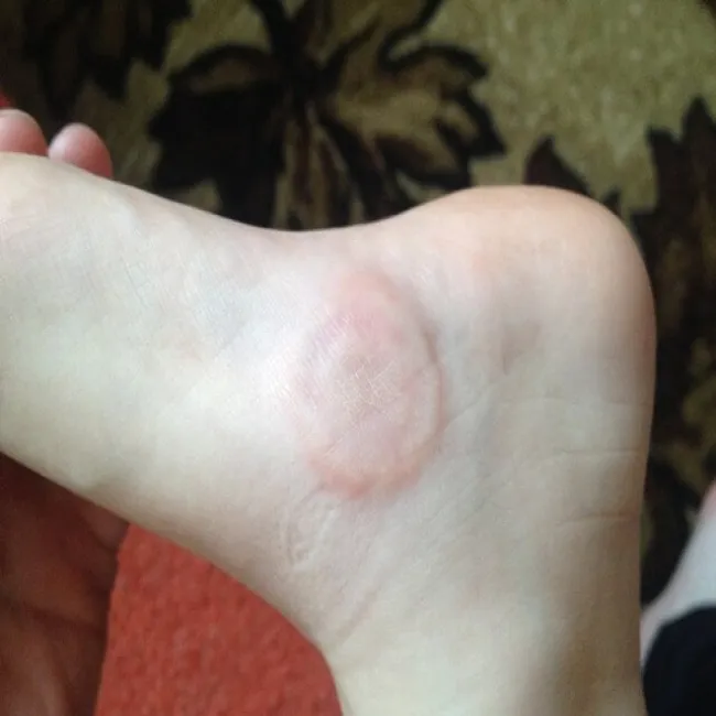 ziarniniak obrączkowaty u dzieci