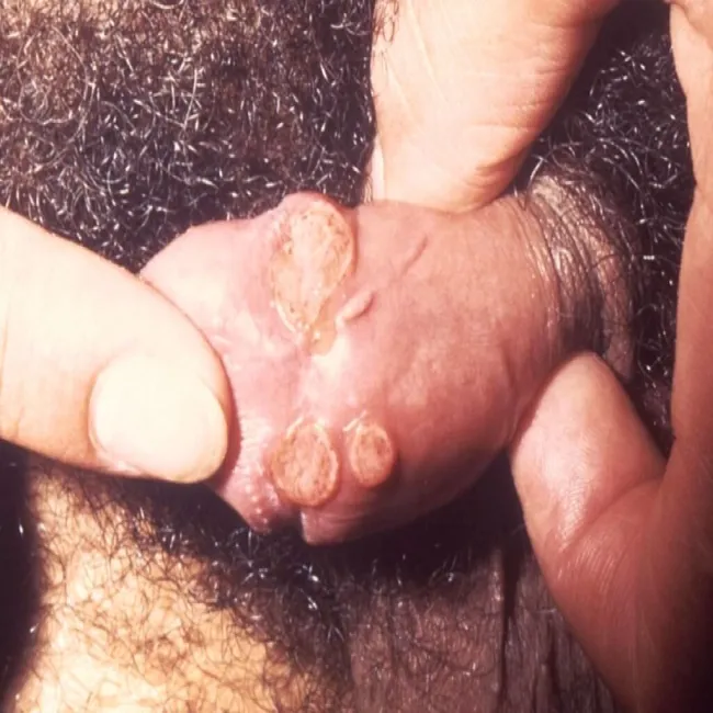 ziarniniak pachwinowy zdjęcie