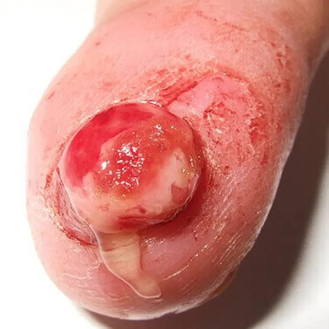 ziarniniak ropotwórczy choroba