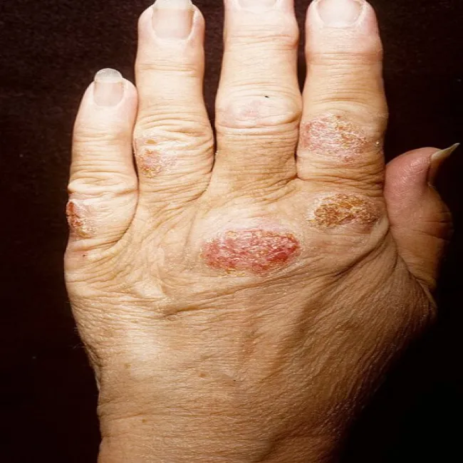 zmiana skórna na dłoni wyprysk pieniążkowaty