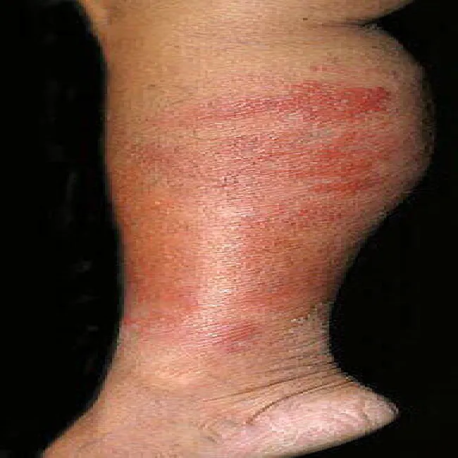 Zmiany na skórze choroba róża