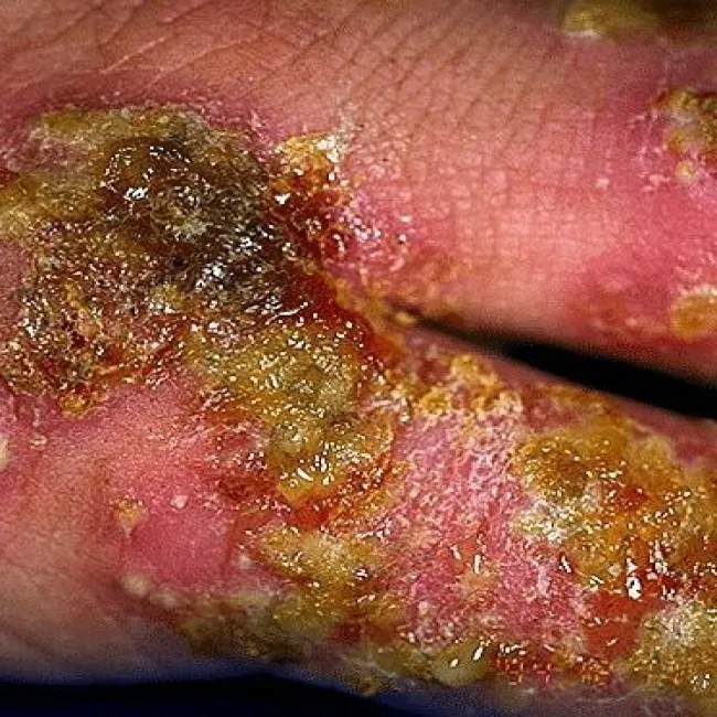 zmiany skórne na dłoniach liszajec