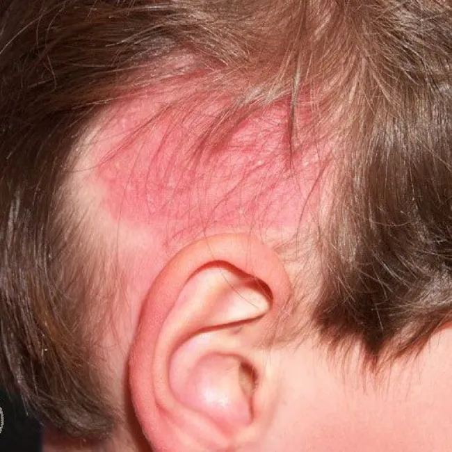 zmiany skórne na głowie u dziecka