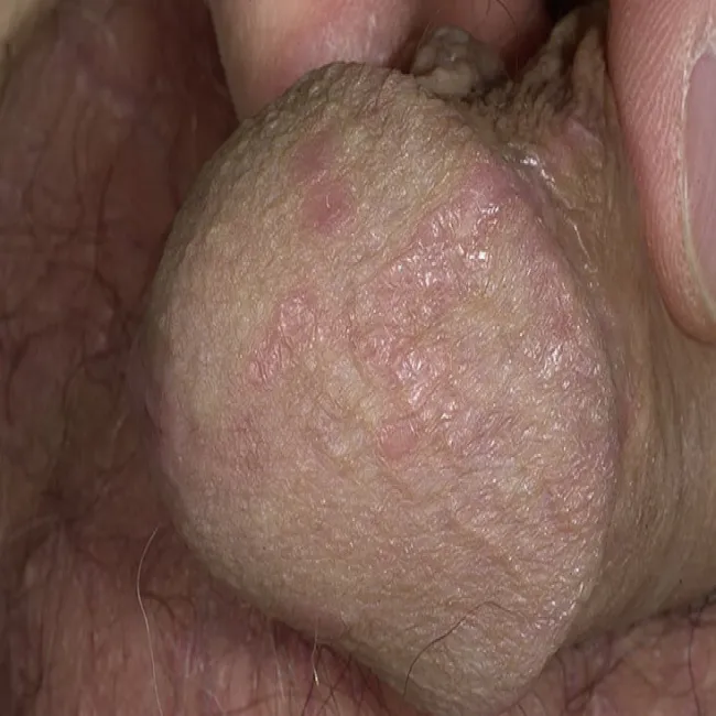 zmiany skórne na genitaliach liszaj płaski