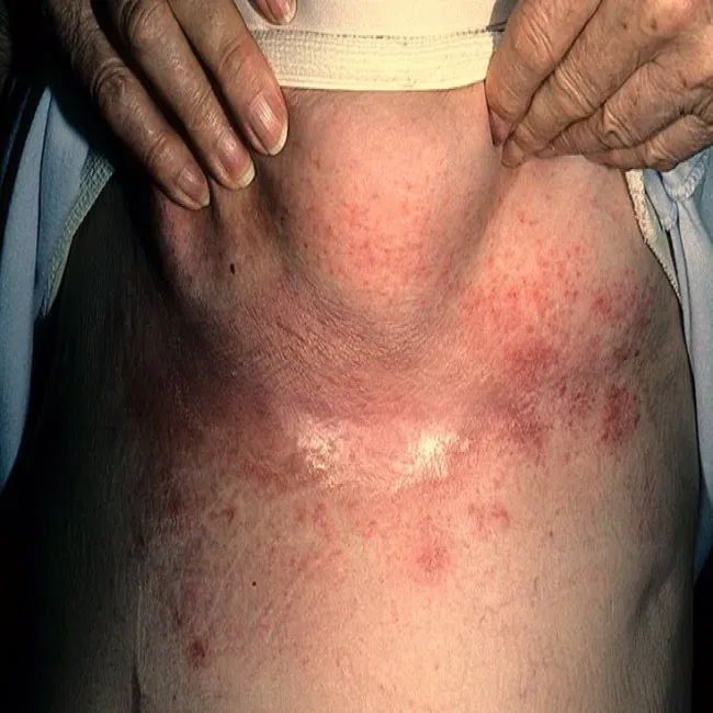 zmiany skórne na piersiach odparzenia