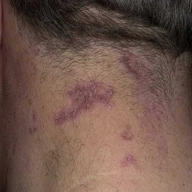 zmiany skórne na szyi liszaj płaski