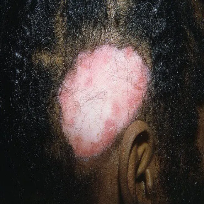 zmiany skórne w toczniu na głowie