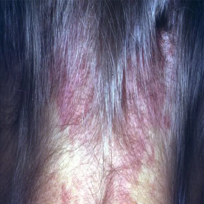 znamię naczyniowe płaskie na szyi u dorosłego