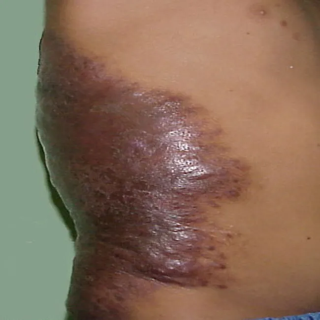 znamiona barwnikowe wypukłe