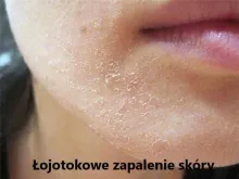 Łojotokowe zapalenie skóry 