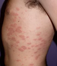 Łupież różowy Gilberta