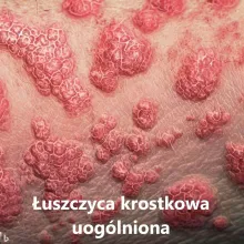 Łuszczyca krostkowa uogólniona, rozsiana, obrączkowata typu von Zumbusch 