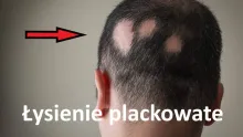 Łysienie plackowate 