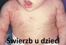 Świerzb u dzieci, Świerzb u dziecka
