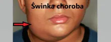 Świnka choroba