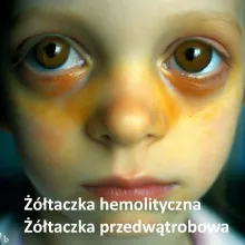 Żółtaczka hemolityczna, żółtaczka przedwątrobowa 