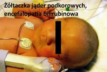 Żółtaczka jąder podkorowych, encefalopatia bilirubinowa