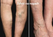 Żylaki na nogach, żylaki kończyn dolnych
