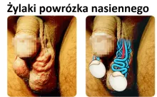 Żylaki powrózka nasiennego 