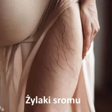 Żylaki sromu
