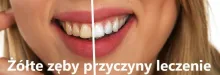 Żółte zęby 