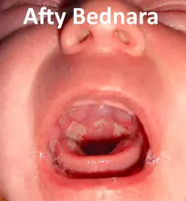Afta Bednara, afty Bednara, owrzodzenie, rany
