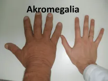 Akromegalia 