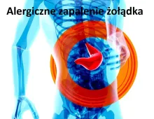 Alergiczne zapalenie żołądka 