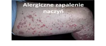 Alergiczne zapalenie naczyń 